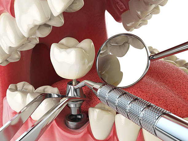 Best Emergency Wisdom Tooth Extraction in Eastern Goleta Valley, CA